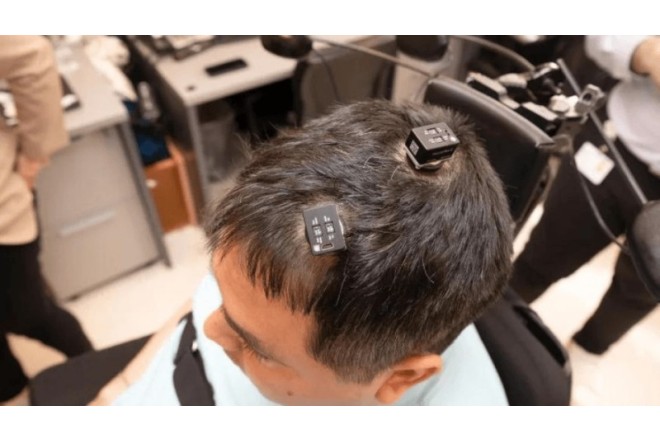 Britaniyada xəstələr üçün beyin implantı icad edilib 