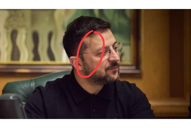 Zelenskinin üzünə nə olub? - FOTO