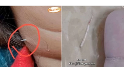 Boğazında qalan balıq sümüyü boynunu deşib çölə çıxdı - FOTO