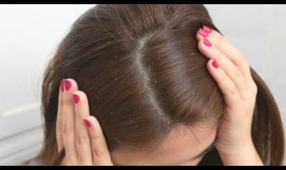 Kəpəyə qarşı effektiv şampunu necə seçə bilərik? 