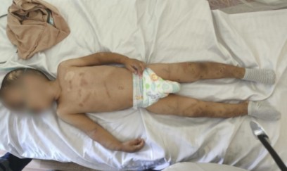 Valideynləri tərəfindən döyülən körpə süni nəfəs aparatına qoşuldu