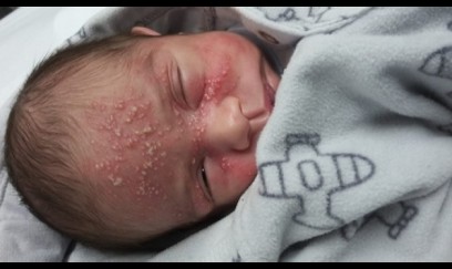 Alimlər herpes virusuna qarşı mini-antikorlar hazırlayıb