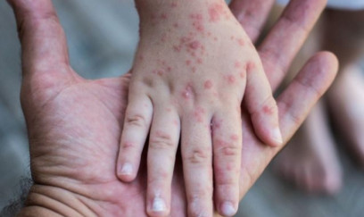 Suçiçəyi Azərbaycanda yayıldı? - Rəsmi məlumat