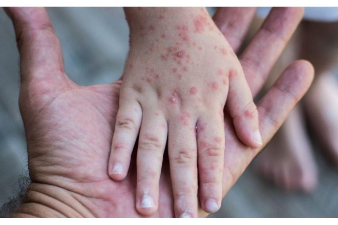 Suçiçəyi Azərbaycanda yayıldı? - Rəsmi məlumat