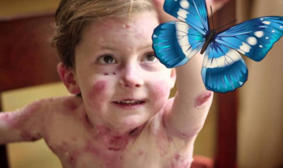 Kəpənək xəstəliyi ilə mübarizəyə 1,3 milyon vəsait ayrıldı