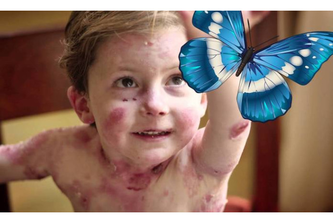 Kəpənək xəstəliyi ilə mübarizəyə 1,3 milyon vəsait ayrıldı