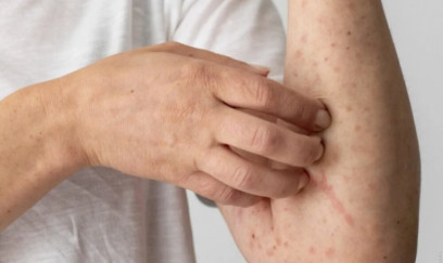 KİV: Londonun şimalında qızılca xəstəliyi yayılıb 