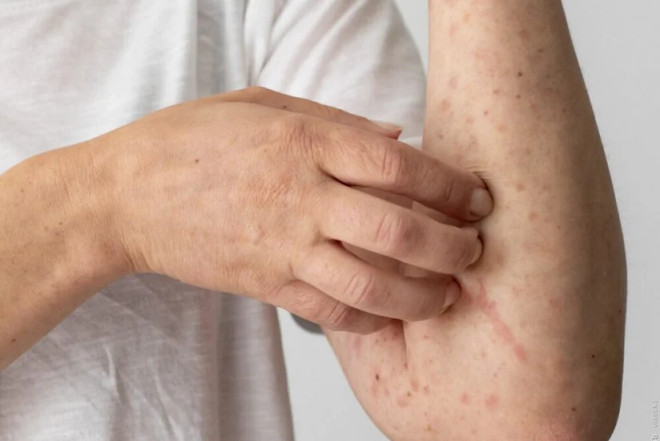 KİV: Londonun şimalında qızılca xəstəliyi yayılıb 