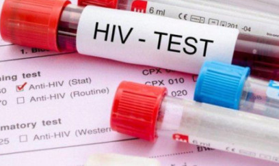 Azərbaycanda 1287 nəfər QİÇS-ə yoluxub 