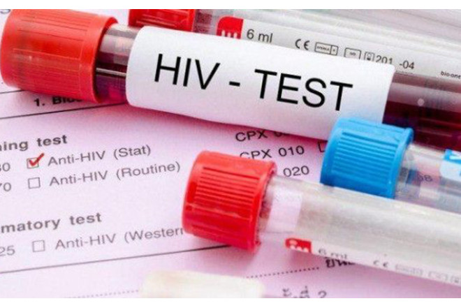 Azərbaycanda 1287 nəfər QİÇS-ə yoluxub 