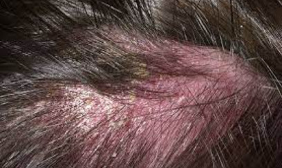 Saç dərisində kəpək və ekzemaya qarşı təbii həll yolları