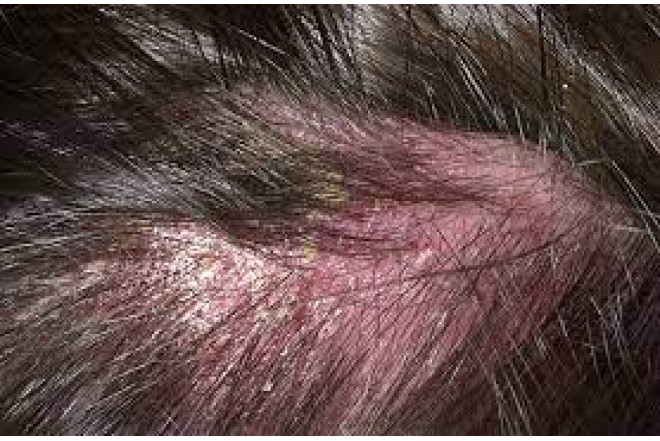 Saç dərisində kəpək və ekzemaya qarşı təbii həll yolları