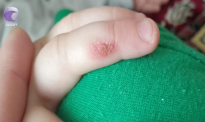 “3 yaşlı uşağım bağçada ağlayanda bıçağı qızdıraraq əlinə basıb” - VİDEO + YENİLƏNİB