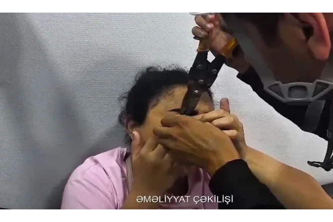 Göz qapağı zəncirbəndə ilişdi, FHN yardım etdi - 