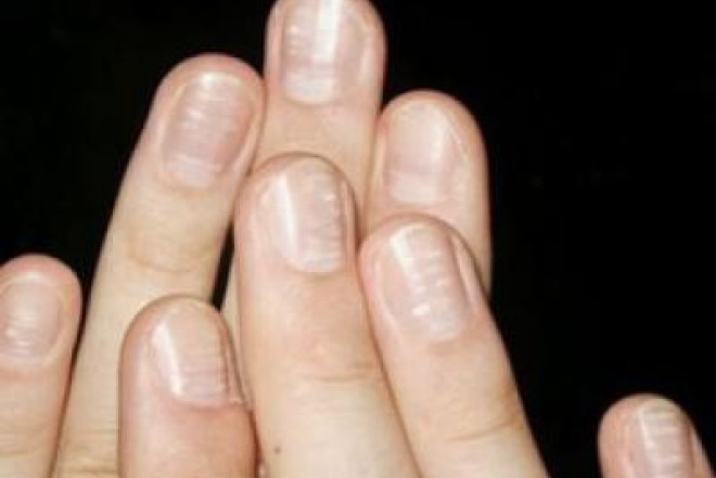 Dırnaqdakı kiçik xətt həyatınızı qurtara bilər! - Dermatoloqlardan xərçəng XƏBƏRDARLIĞI