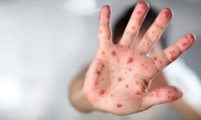 Qızılca və suçiçəyi ilə bağlı epidemioloji vəziyyət - RƏSMİ