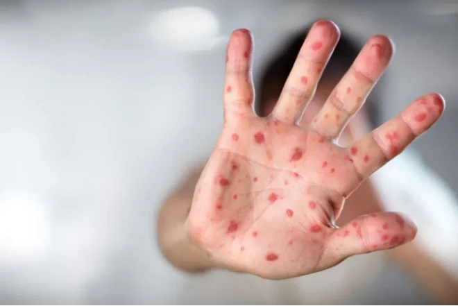Qızılca və suçiçəyi ilə bağlı epidemioloji vəziyyət - RƏSMİ