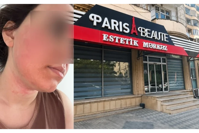 “Lazeroloq üzümü yandırıb...” - Foto