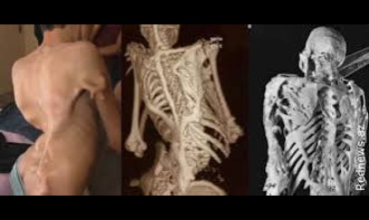 FOP – insanı tədricən “sümüyə çevirən” nadir xəstəlik 
